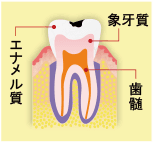 軽度のむし歯