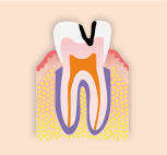 中度のむし歯