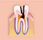 重度のむし歯