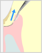 歯周ポケット掻爬術