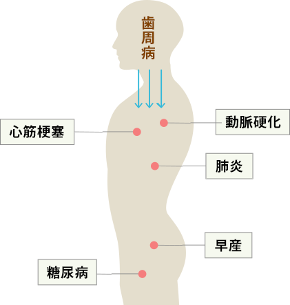 歯周病と全身疾患の関連