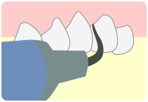 1.歯石の除去